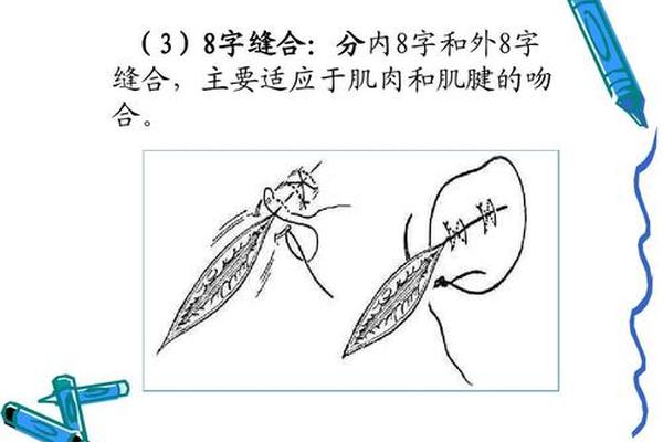 八字缝合图解 八字缝合图解