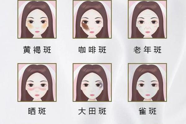 痣和斑相—痣与斑的区别图片