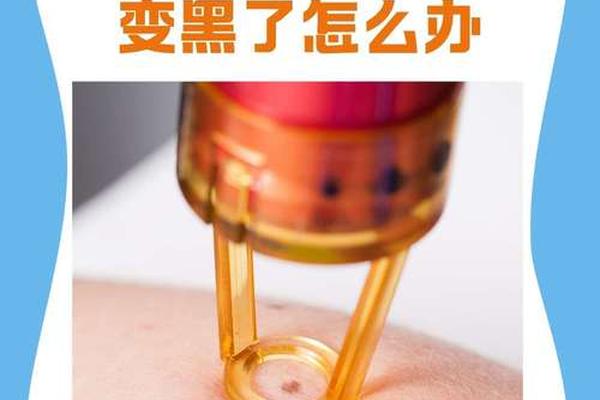 火针治疗与皮肤相平的痣_火针祛痣几天可以恢复