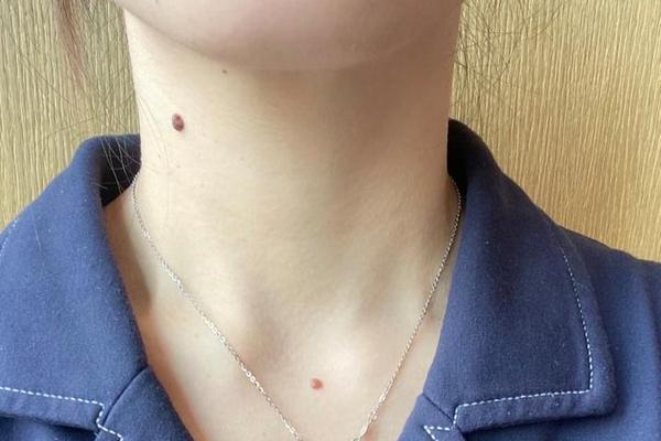 痣相脖子左侧面有两颗痣、脖子左侧有两个痣