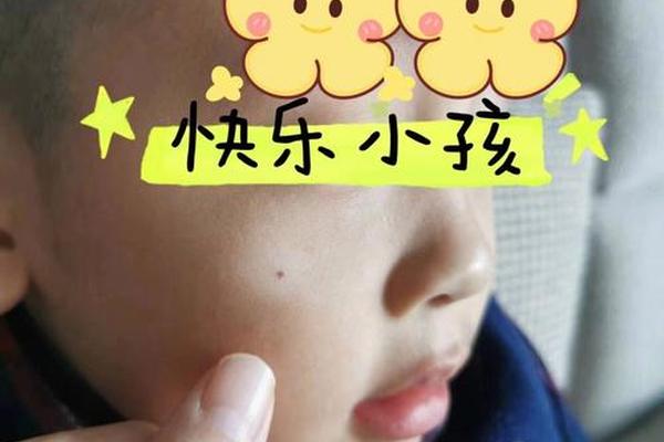 痣相是白色的好吗(白色痣是怎么回事)