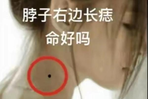 女人左边脖子痣相最准图(脖子上痣相最准图)