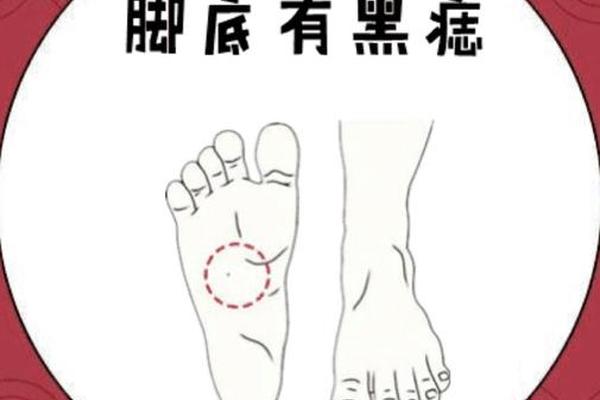 脚侧的痣相(脚侧有痣图解)