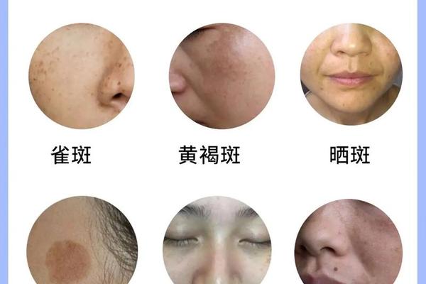 斑点是痣相之内一种吗,斑和痣有什么区别 斑点是痣相之内一种吗,斑和痣有什么区别