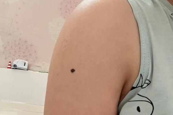 脖子与肩膀之间痣相_肩膀靠近脖子地方有痣