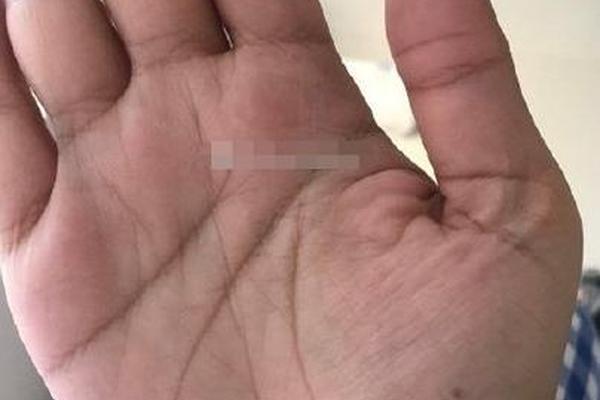 痣相龙珠是 金星丘突然长痣