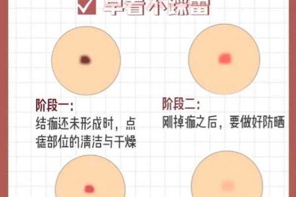 郑州看痣相点痣、郑州人名医院点痣在哪个院区