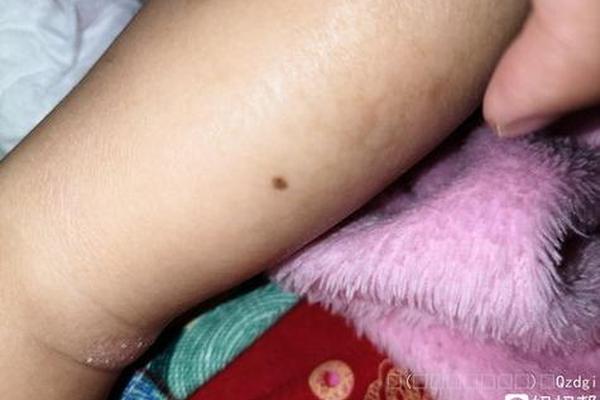 痣相女腿—大腿内侧有痣的女人代表什么