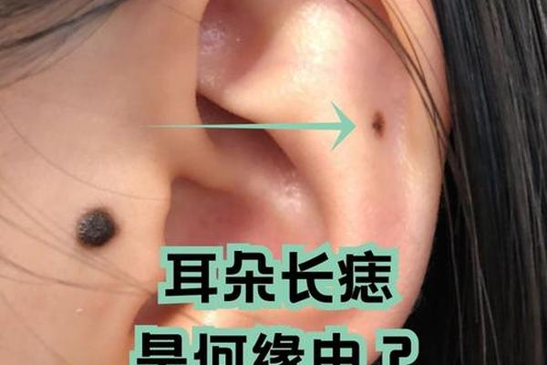 宝贝的痣长在相窝里好吗;耳朵窝里长痣的寓意