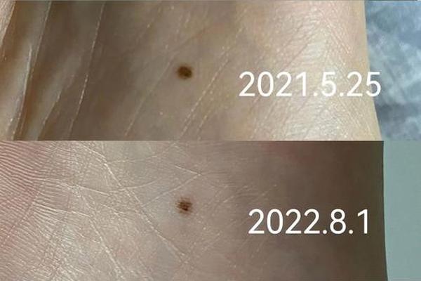 脚痣相喜的含义-脚上长痣图解大全
