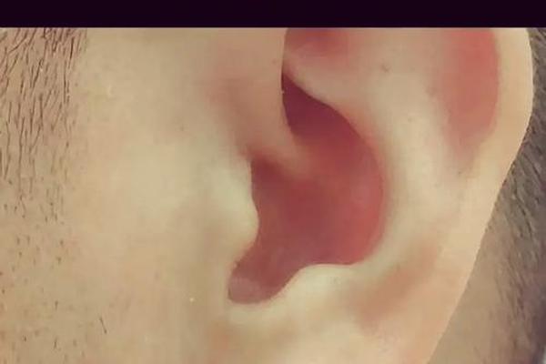 耳垂有痣相壁虎眼睛一样—耳垂上有个肉丁是福相