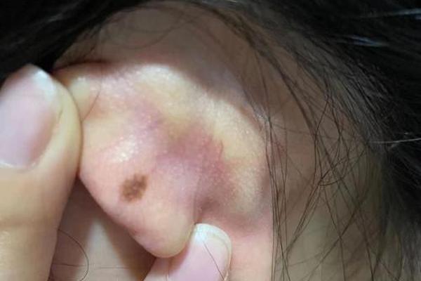 女人耳后痣相最准图_耳垂后有痣的女人