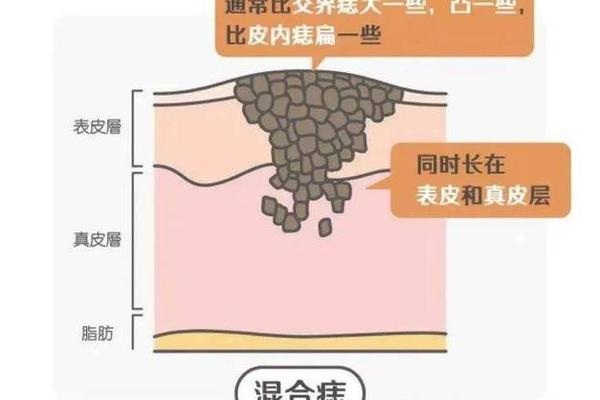 阴上长痣相-外阴长痣是什么意思 阴上长痣相-外阴长痣是什么意思