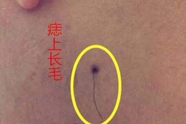 香港痣相之长三根毛_痣上长毛叫一毛孤三毛富吗