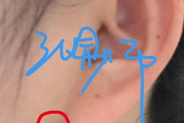 痣相耳垂_耳垂上有痣