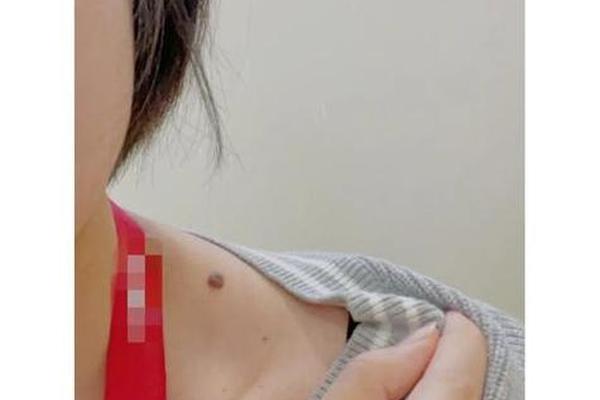 斜方肌有痣的男人体相(肩膀和背上有痣好不好)