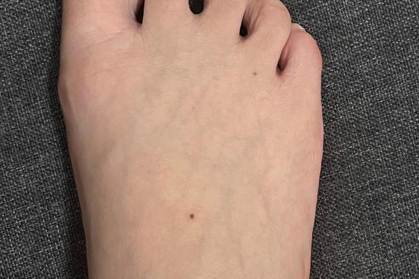 脚痣相附的传说-左脚有痣女人 脚痣相附的传说-左脚有痣女人