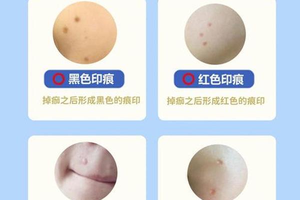 痣相无疤祛痣(祛痣留下的疤痕怎样消除)