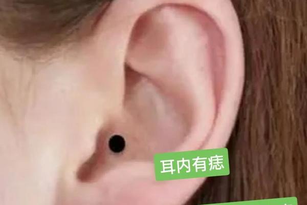 麻衣相法耳朵长痣 耳朵里面长痣好不好