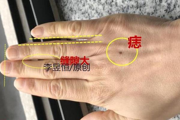 男人手背痣相大全图解—手背上长痣的男人