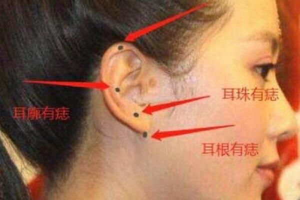 耳朵外侧痣相代表什么_耳朵外面长痣代表什么意思