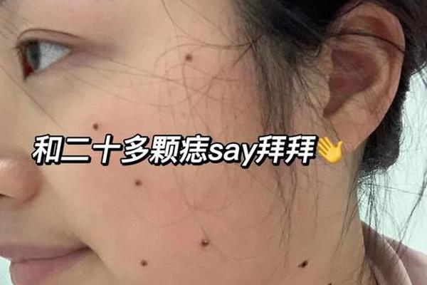 韩国观相点痣视频大全集_点痣视频祛痣视频