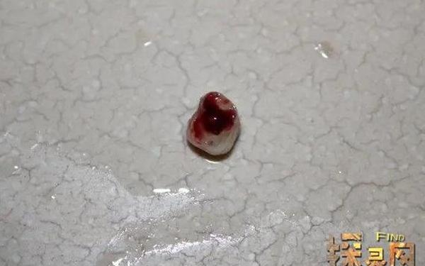 梦见假牙掉了又按上去了 男人梦到自己假牙掉了 梦见假牙掉了又按上去了 男人梦到自己假牙掉了