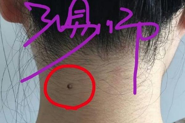 痣相解说后颈项(后颈痣的位置代表什么意思)