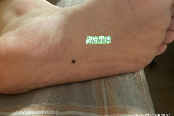 痣相女人脚底痣相图解、脚底痣图片大全图解