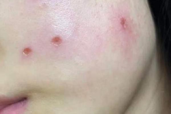 相城激光点痣医院在哪里_激光点痣疼吗
