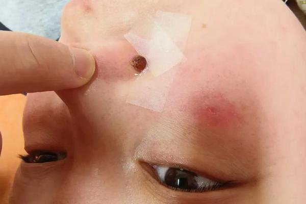 观相鼻子点痣好吗,鼻子上面的痣可以点吗面相 观相鼻子点痣好吗,鼻子上面的痣可以点吗面相
