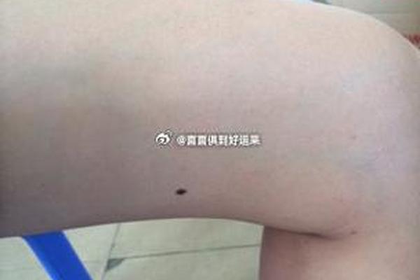 大腿根相痣 大腿根长痣代表什么 大腿根相痣 大腿根长痣代表什么