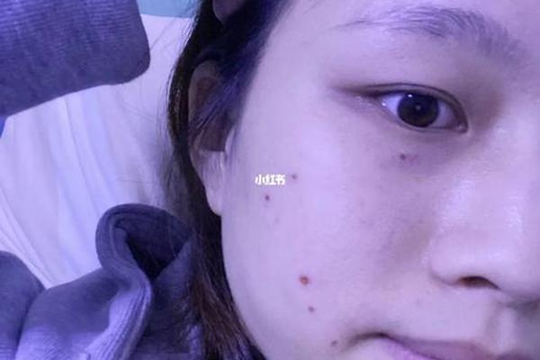 相城有点痣的地方没,苏州点痣多少钱一颗 相城有点痣的地方没,苏州点痣多少钱一颗