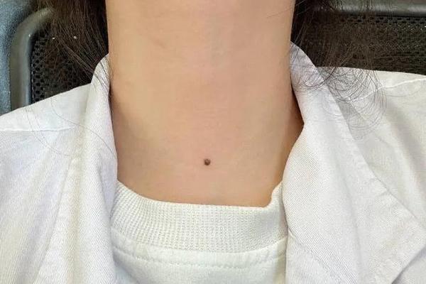 女人脖子痣相最准图左右,男人身上痣相最准图