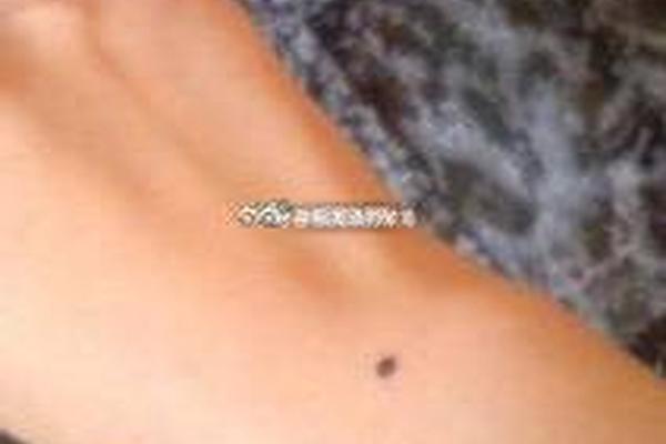 手腕痣相解析(手腕的痣的位置与命运图解)