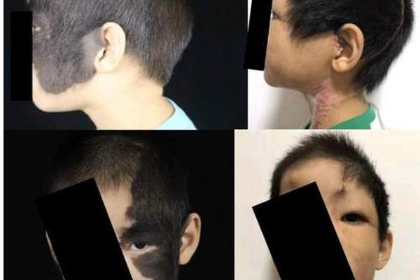 痣相男的蛋上两个黑痣,蛋蛋上长黑色的黑痣 痣相男的蛋上两个黑痣,蛋蛋上长黑色的黑痣