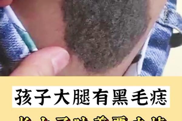 男人大腿有痣相,大腿上有痣图解 男人