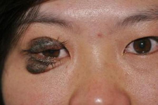 痣相眼皮长红痣_眼皮长个红痣代表什么意思 痣相眼皮长红痣_眼皮长个红痣代表什么意思