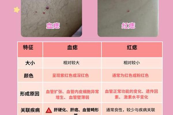 痣相肋下长红痣好不好 大腿内侧有红痣代表什么意思