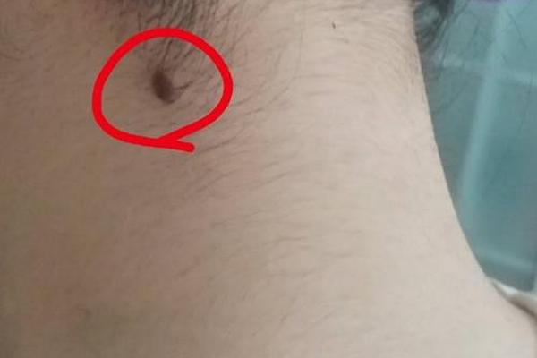 痣相男脖子后面_男人脖子后面有痣好吗