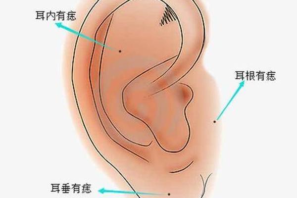 痣相耳朵部位,痣在耳朵图片大全