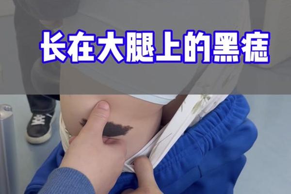 大腿底下中间痣相-大腿中间有痣代表什么