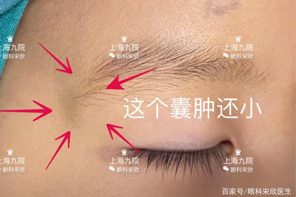 眼匡边长痣相怎么样—眼眶边长了一个硬块