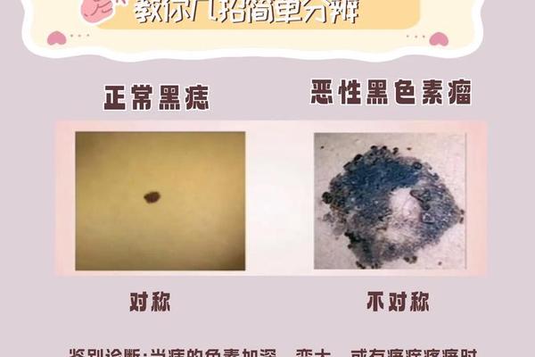 黑痣与红痣相法区别,正常红痣的图片