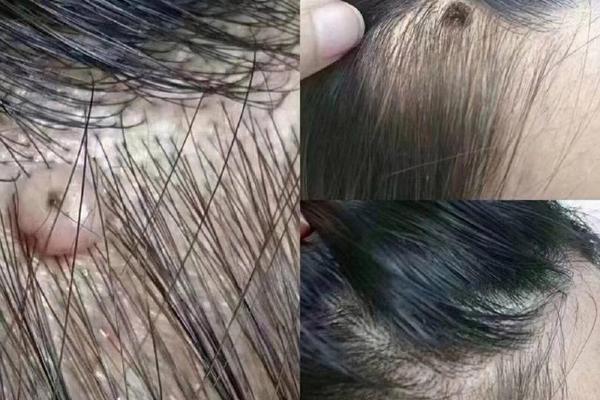 左侧头发丝里有痣相—左侧头发里有痣好不好