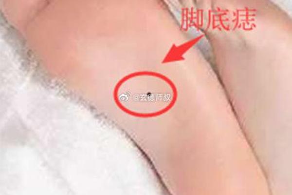 脚背红痣相 脚背的痣图解