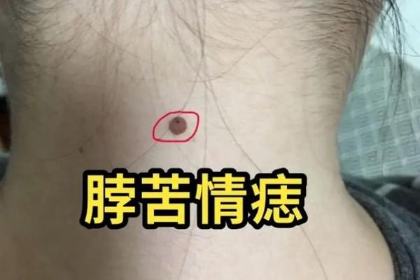 后背痣相寓意(后背的痣代表什么意思)