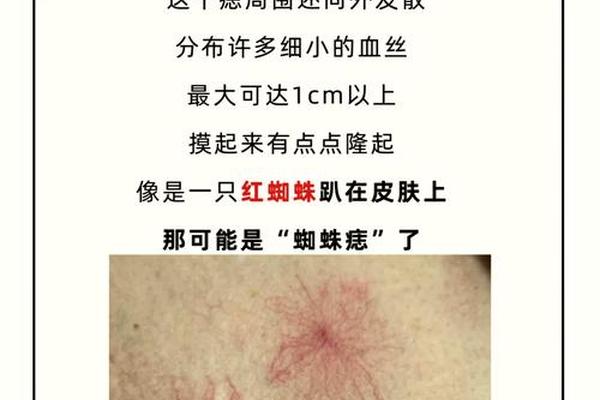 肚子长红痣痣相-肚子长红痣是什么征兆
