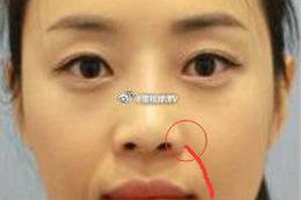 翼点痣相,鼻翼的痣能点掉吗
