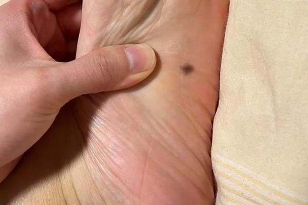右脚底有痣的男人相;男人右脚底一颗痣什么命
